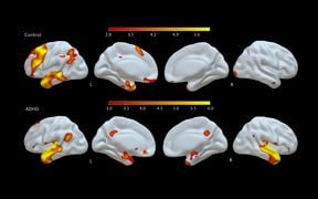 Brain activations in ADHD and controls