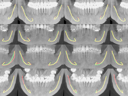 Useita rinnakkaisia röntgenkuvia leuasta ja hampaista. Kuviin on merkitty keltaisella alaleuan hermokanavan sijainti.
