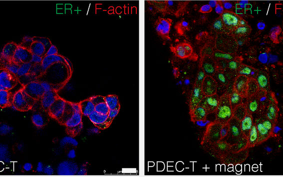 Microscopeimage of breast cancer