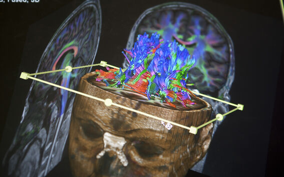 3D brain scan on screen showing colourful neural pathways inside a semi-transparent head model