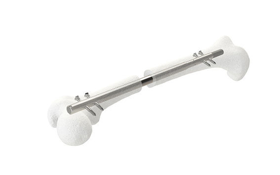 Synoste uses an implantable and telescopic lengthening nail that utilize smart materials and are inserted into the intramedullary canal of the bone.