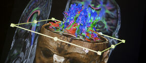 3D brain scan on screen showing colourful neural pathways inside a semi-transparent head model