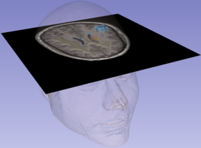 A nearly profiled angle captures a semi-transparent human head merged with a brain MRI slice, featuring various labelling techni