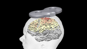 TMS coil on the head surface induces an electric field in the brain.