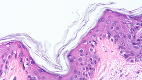 Mikroskooppikuva kerroksittaisesta vaaleanpunaisesta ja violetista ihokudoksesta, pinta hilseilee