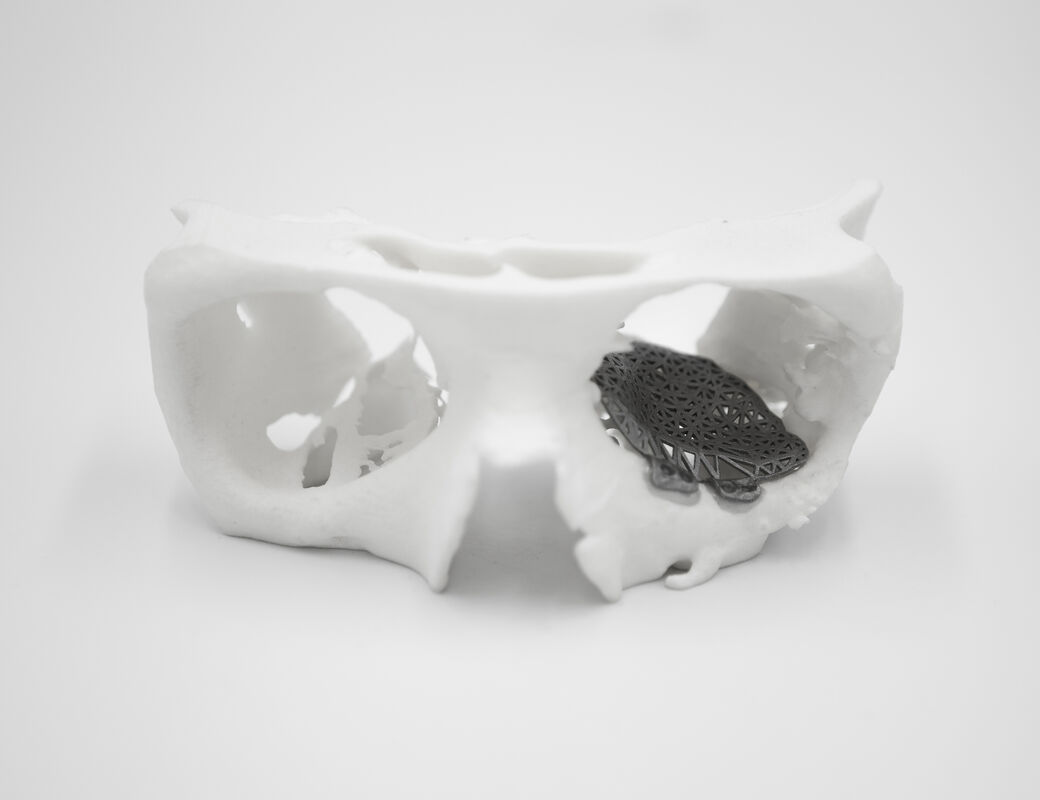 Patient-specific reconstruction with 3D modeling and DMLS additive manufacturing | Mika Salmi