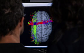 Mies katselee tietokoneruudulta kuvaa aivoista