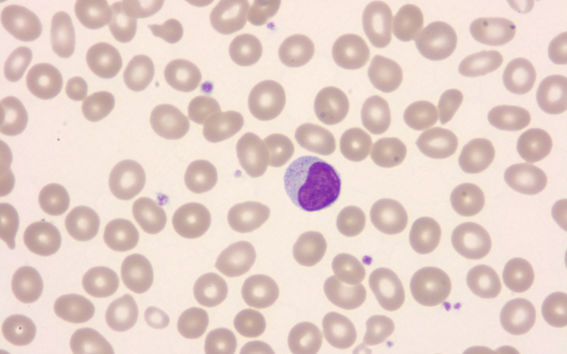 an illustration of large granular lymphocyte leukemia cell