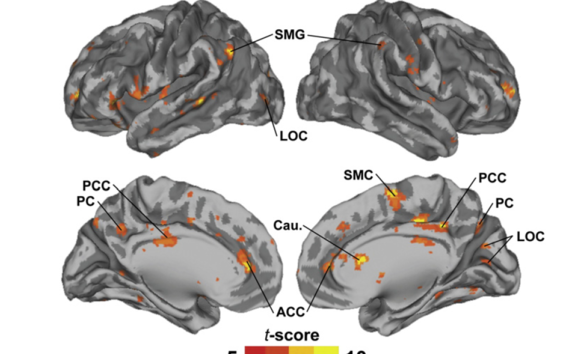 Volume renders of the brain showing regions where ISCs were larger (P b 0.05 FDR corrected) in NT than ASD group. SMG, supramarginal gyrus; LOC, lateral occipital cortex; PCC, posterior cingulate cortex; PC, precuneus; ACC, anterior cingulate cortex; Cau, caudate nucleus; SMC, supplementary motor cortex.
