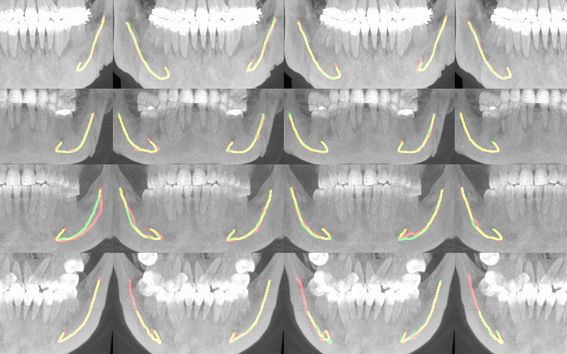 Useita rinnakkaisia röntgenkuvia leuasta ja hampaista. Kuviin on merkitty keltaisella alaleuan hermokanavan sijainti.