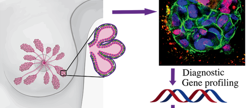 The ability of 3D matrix to maintain the cellular identity and heterogeneity of patient derived cancer tissues allow individualized breast cancer therapy approach. Image: Lahja Martikainen, Pauliina Munne and Nonappa.