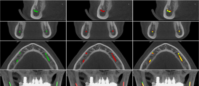 CBCT scan showing the location of the mandibular canals in the lower jaw