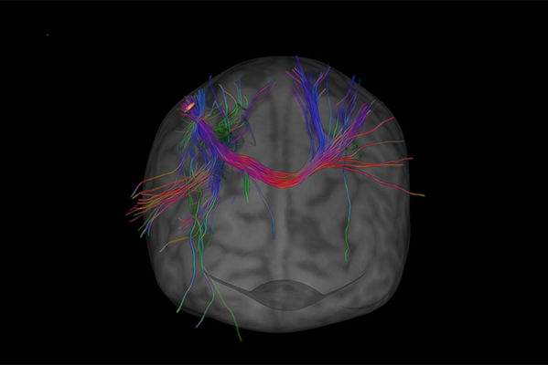 brain scan with colourful lines showing the connections between different parts