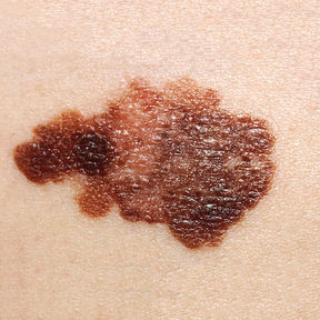 picture of melanoma on human's skin