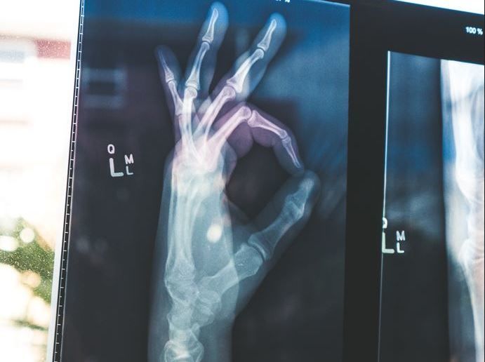 Röntgenkuva, jossa sormet näyttävät ok-merkkiä.