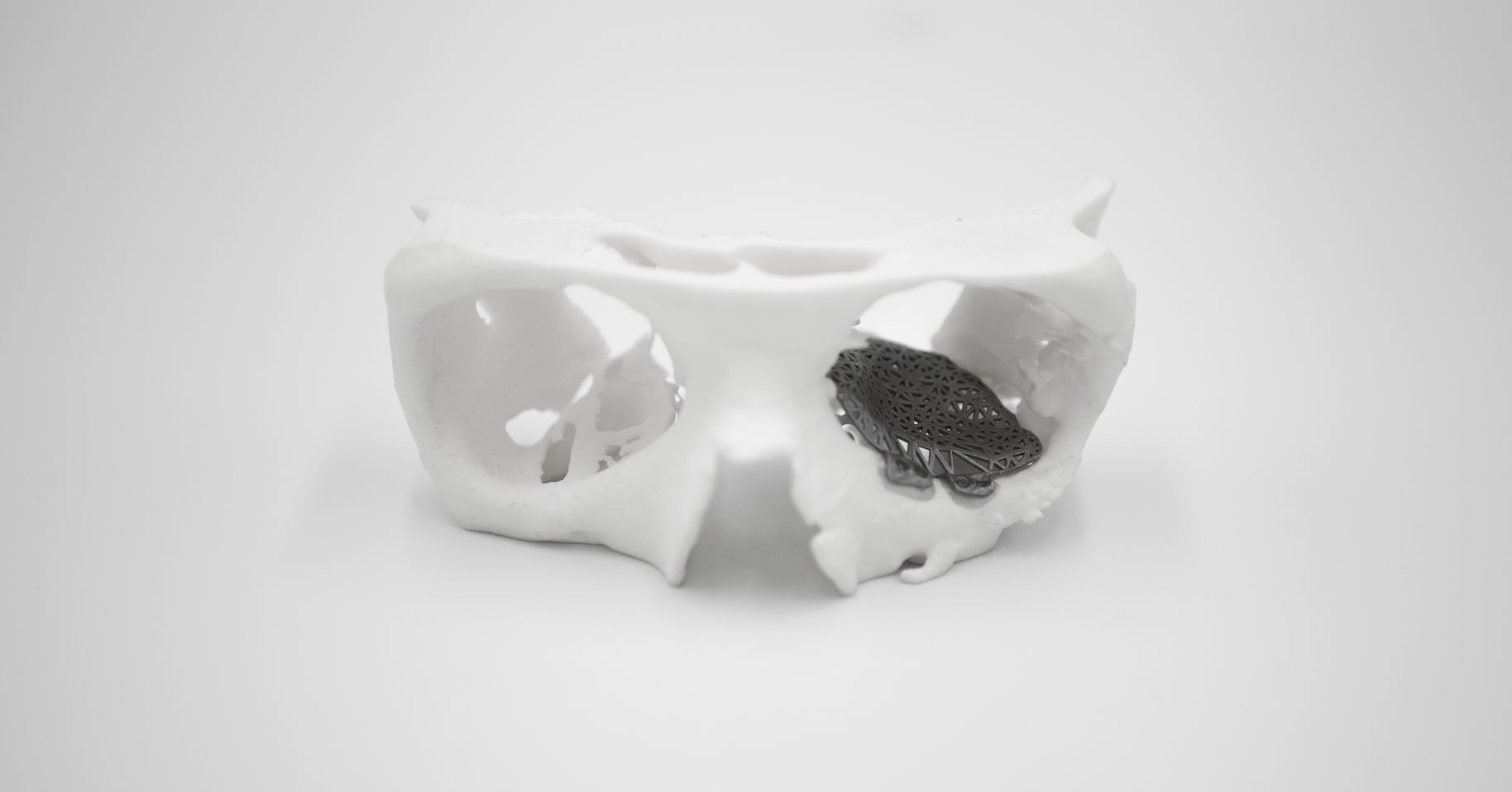 Patient-specific reconstruction with 3D modeling and DMLS additive manufacturing | Mika Salmi